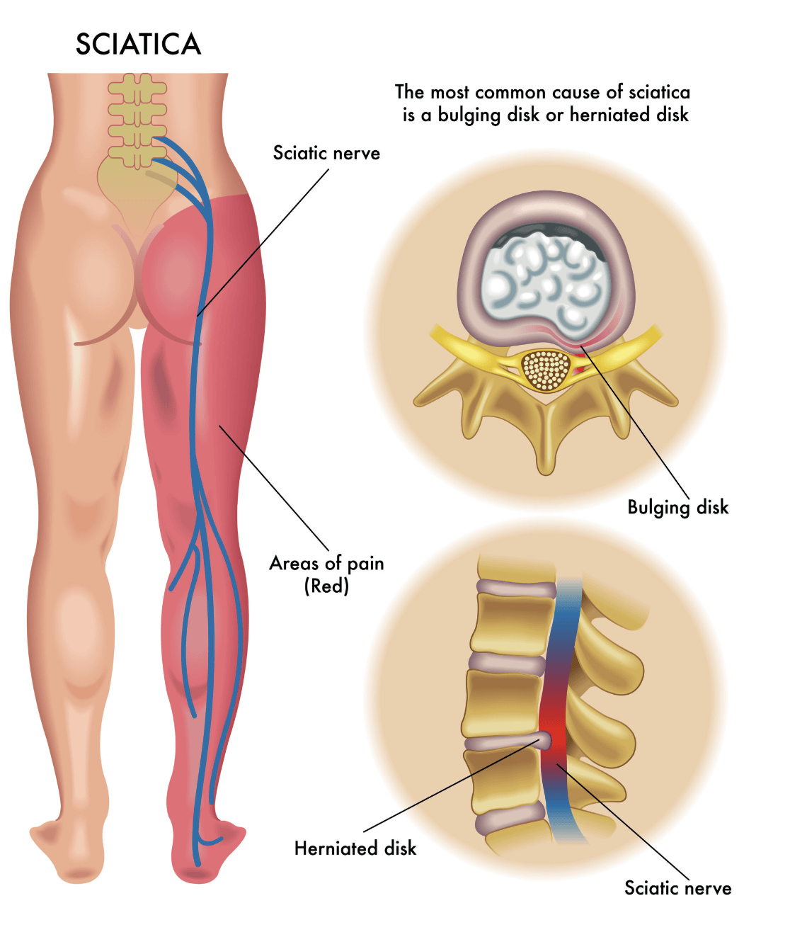 sciatica explained