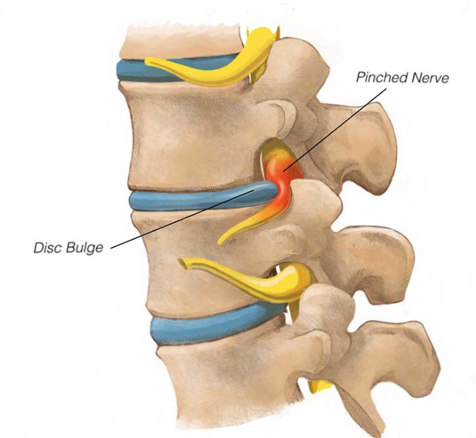 pinched nerve from bulging disk