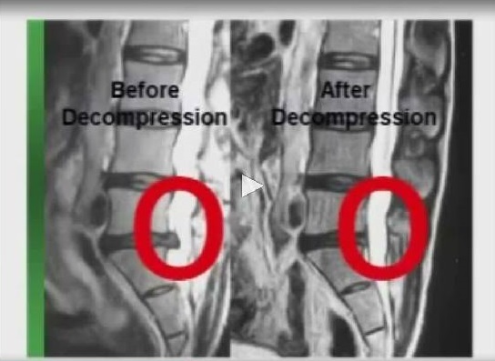 DECOMPRESSION before after 2