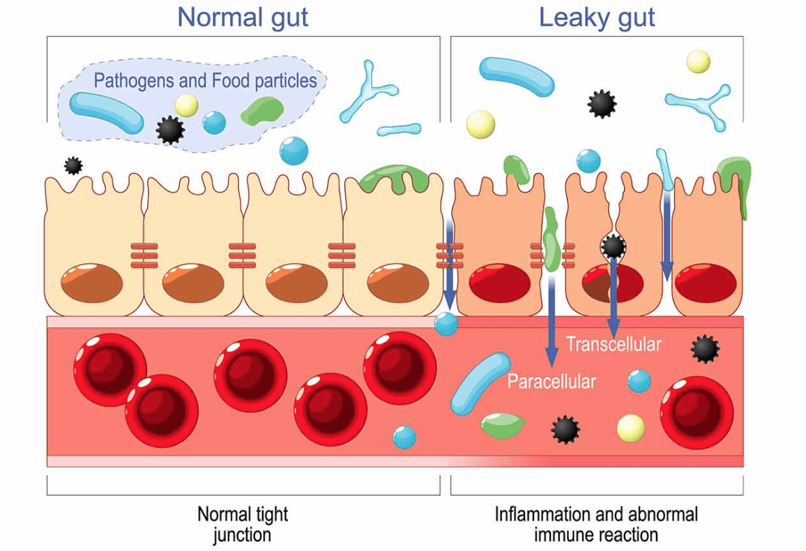 leaky gut